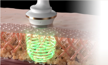 Mikrovågsbehandling med Cryosculpt Fusion Extreme Black Week 2025